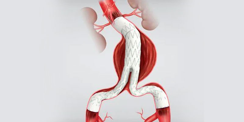 Endovascular Aortic Repair