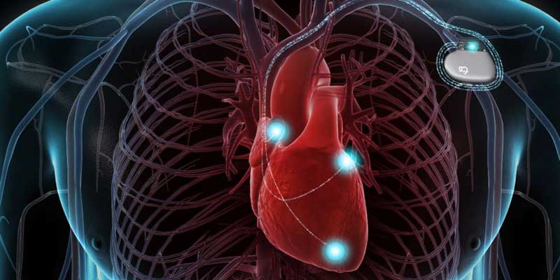 ICD Implantation