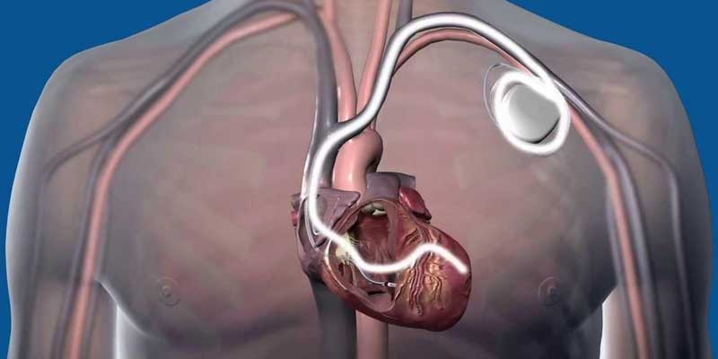 CRT-D Implantation