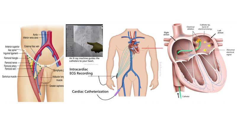 Electrophysiological Study