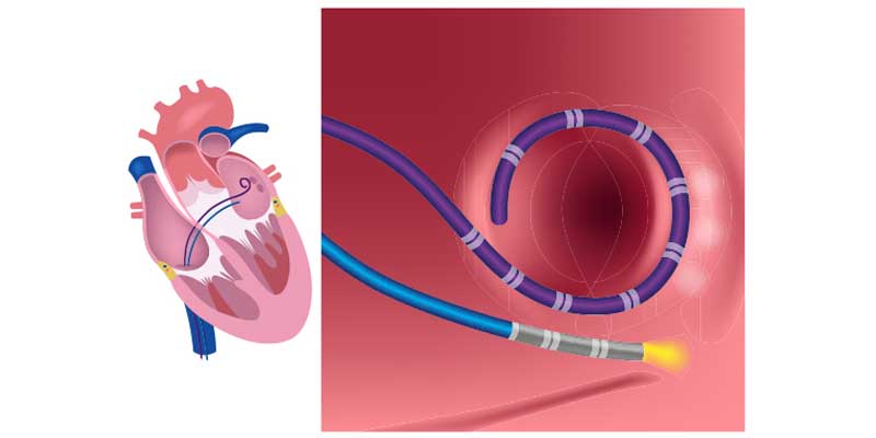 Catheter Radiofrequency Ablation
